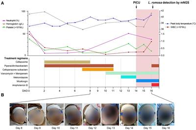 Case report: The clinical utility of metagenomic next-generation sequencing in mucormycosis diagnosis caused by fatal Lichtheimia ramosa infection in pediatric neuroblastoma